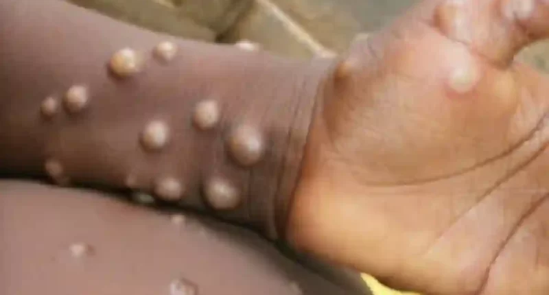 South Africa's first monkeypox case confirmed in Johannesburg