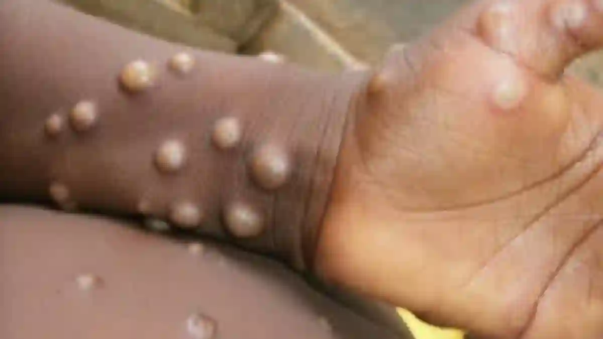 South Africa's first monkeypox case confirmed in Johannesburg